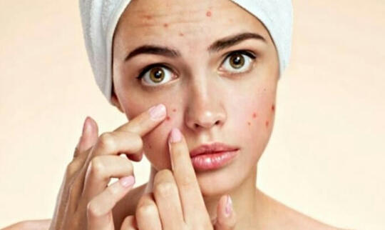Karantina Bukannya Glowing Muka Malah Jerawatan? Ini Solusinya!