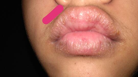 Balasan Dari Bibir Gatal Dan Bintik Berair Kaskus