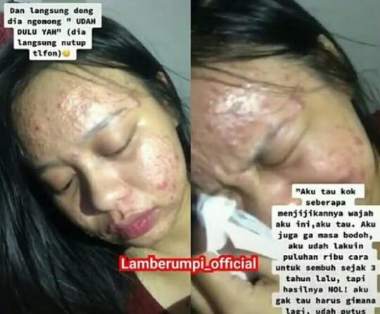 Viral Curhat Sedih Pejuang Acne Ditolak Cowok Gegara Jerawatan