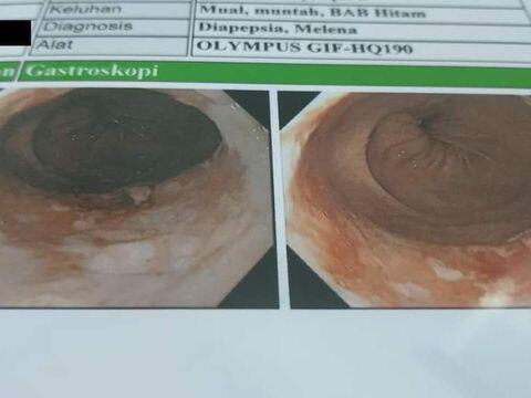 Kasihan, Pria Ini Dilarang Makan Mie Instan Seumur Hidup. Ada Apa Gerangan?
