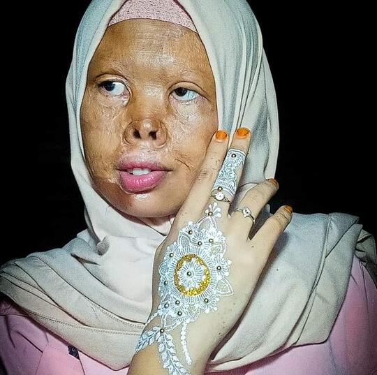 Dibully Karena Kekurangan Fisik, Wanita Ini Tetap Bersyukur Dan Percaya Diri