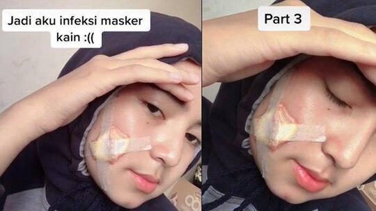 Viral Kisah Wanita Berjerawat Karena Masker Kain, Akhirnya Sampai Dioperasi