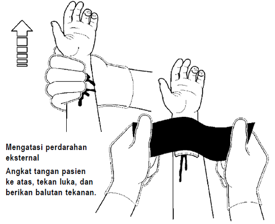 Semua Harus Tahu! Lakukan Langkah Ini Bila Mengalami Luka Robek
