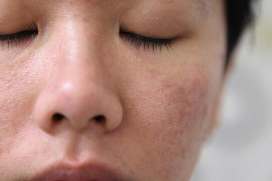 Sudah Pakai Skincare Tapi Kulit Wajah Masih Bermasalah Ini Penyebabnya Kaskus