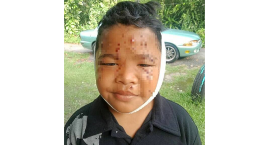 Meski Wajah Terluka Akibat Dicakar, Anak ini Meminta Ayahnya Tidak Memukul Kucing