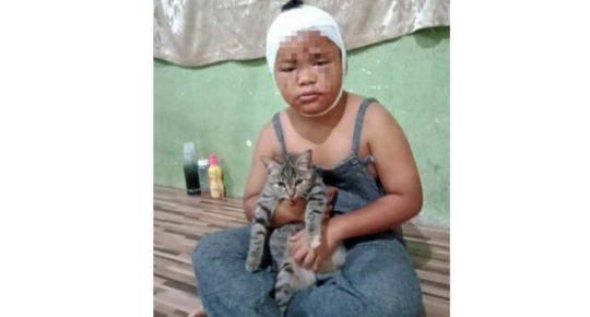 Meski Wajah Terluka Akibat Dicakar, Anak ini Meminta Ayahnya Tidak Memukul Kucing
