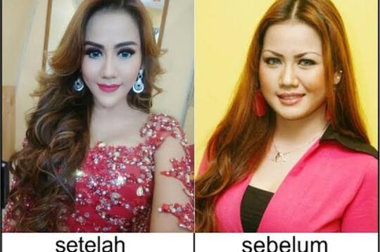 Demi Sebuah Penampilan, Artis Ini Rela Operasi Plastik, Ini Rincian Biayanya!