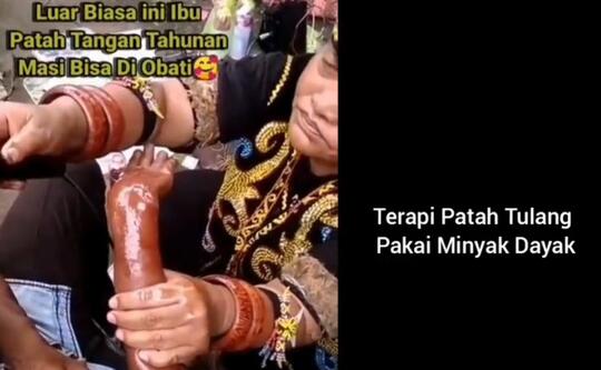 Ampuh, Dengan Gunakan Minyak Bintang Dukun Dayak Ini Sembuhkan Lengan Patah Tulang!