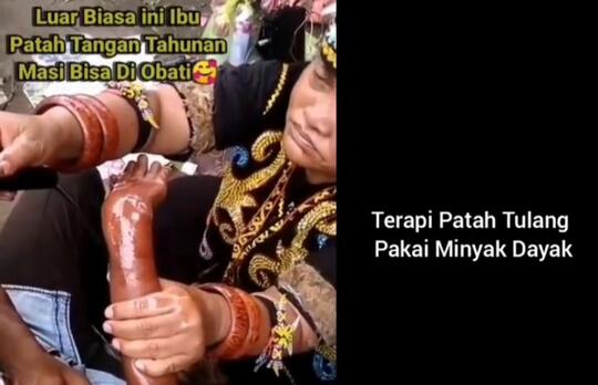 Ampuh, Dengan Gunakan Minyak Bintang Dukun Dayak Ini Sembuhkan Lengan Patah Tulang!