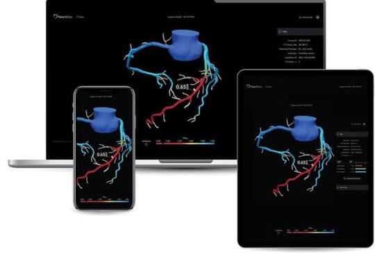 5 Kali Lebih Cepat, Teknologi 3D HeartFlow Bisa Diagnosis dan Analisis Sakit Jantung