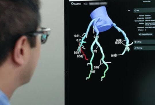 5 Kali Lebih Cepat, Teknologi 3D HeartFlow Bisa Diagnosis dan Analisis Sakit Jantung
