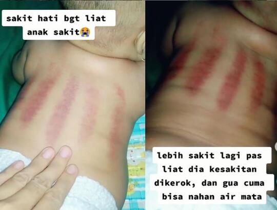 Miris! Takut Dikira Corona, Seorang Bayi Malah Dikerok Sampai Merah Darah. Waras Gan?