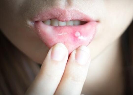 3 Obat Pereda Sariawan, Ampuh!