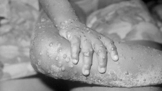 Mewabah di 12 Negara, Ini Dia Gejala, Penularan dan Pencegahan Virus Cacar Monyet