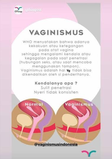 Gara-Gara Vaginismus, Seorang Wanita Bisa Diceraikan Suaminya!