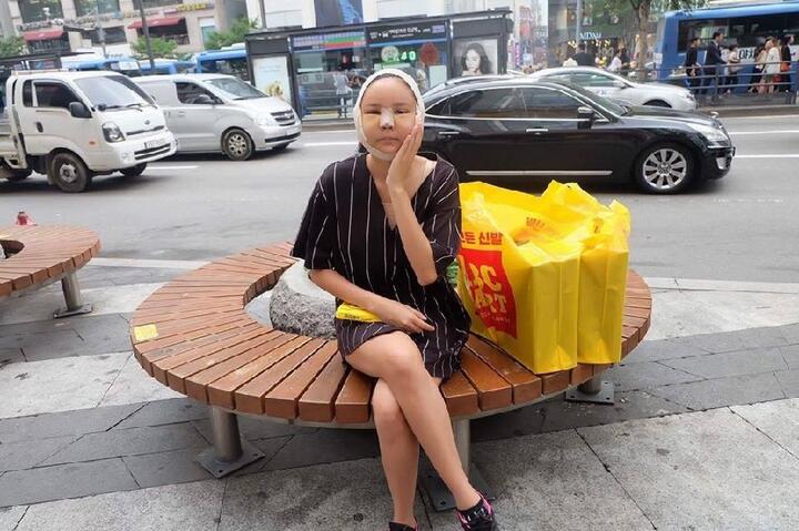 Pasca Oplas, Wajah nya Bengkak! Sempat Dibilang Gagal, Ternyata WOW !!!